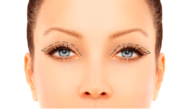 How Much Does Upper Eyelid Surgery Cost? 6 Ways To Lessen Your Expense