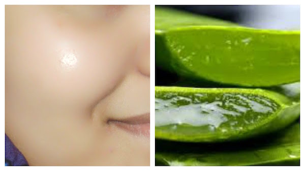 Aloe Vera Gel For Acne - Does It Surely Work?